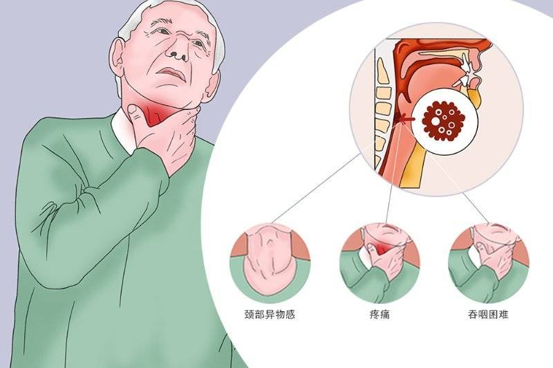 老觉得咽部有异物感?成都民生耳鼻喉医院:警惕下咽癌