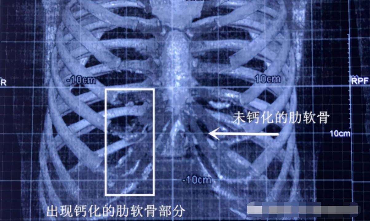 耳再造手术用肋软骨,移植后的软肋会钙化吗?