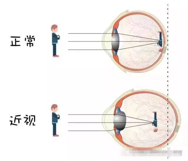 而在视网膜前或后方成像,它包括远视,近视及散光