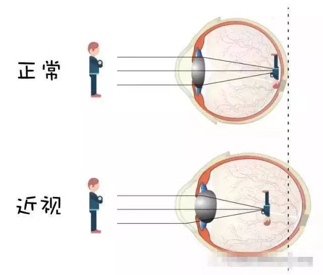 屈光不正-近视屈光不正是指眼在调节静止的状态下,平行光线通过眼的