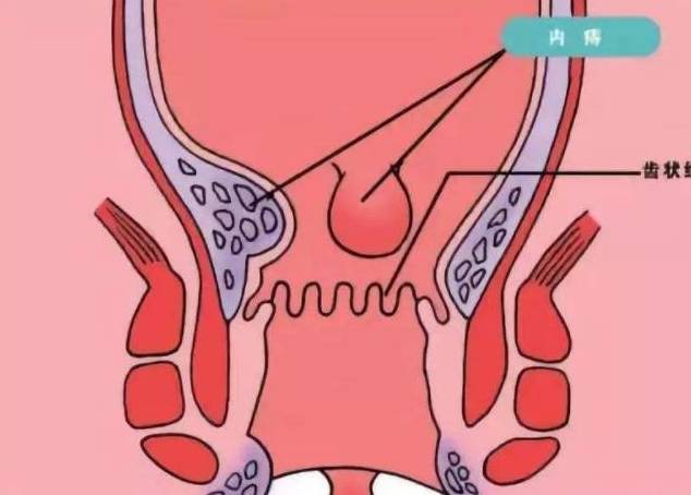 原创肛门附近长出"小肉球",别只以为是痔疮,也可能是这2种疾病