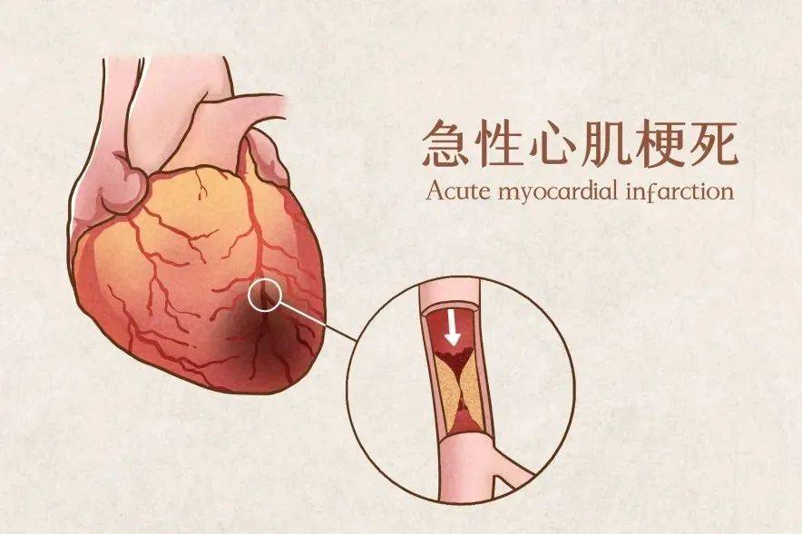 心梗的 标志症状是心绞痛,心绞痛是心脏缺血反射到身体表面所感觉的