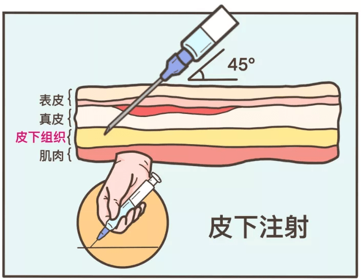 最痛:皮内注射 (代表:打青霉素前做的「皮试」)