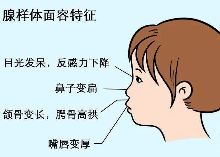 1,易形成"腺样体面容":由于儿童鼻咽部比较狭小,当腺样体肥大时,由于