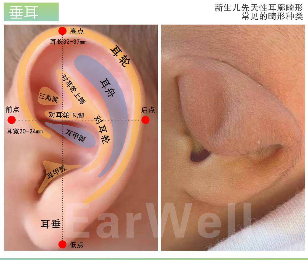 出现这些情况,请注意可能是耳畸形出没!