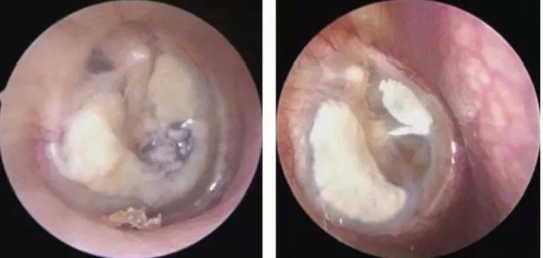 鼓膜病变及中耳疾病耳内镜下表现_外耳道