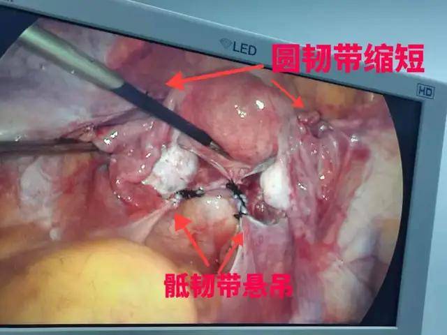 上蔡县人民医院成功为子宫脱垂患者行腹腔镜下骶韧带悬吊术双侧圆韧带