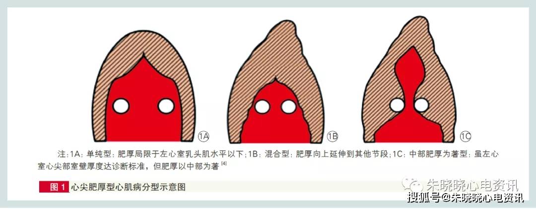 心尖肥厚型心肌病心电图改变