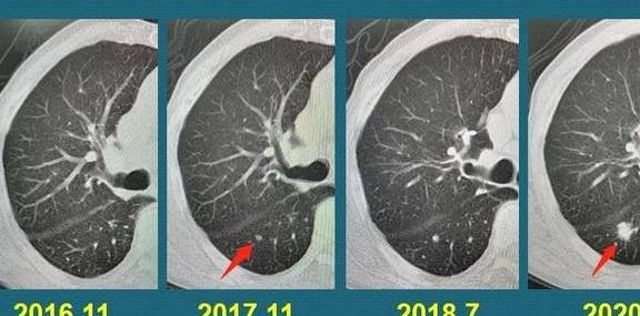 医生教你看ct片,有2种可能是肺癌