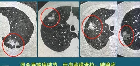 医生教你看ct片,有2种可能是肺癌