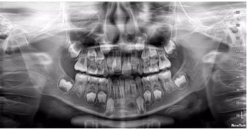 儿童牙科x光片到底会不会有辐射?