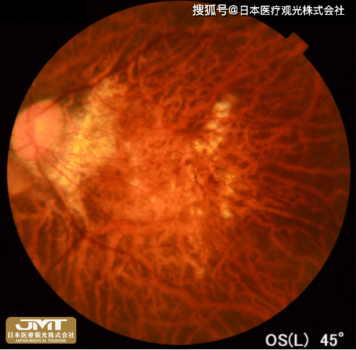 jmt日本医疗-脉络膜新生血管原因是什么?怎么治?