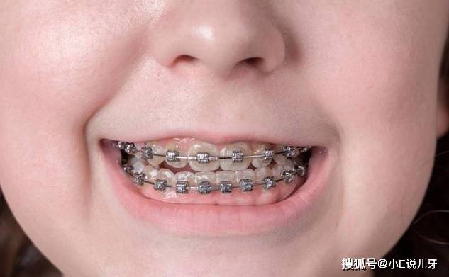 儿童牙齿矫正戴牙套会损坏牙齿吗