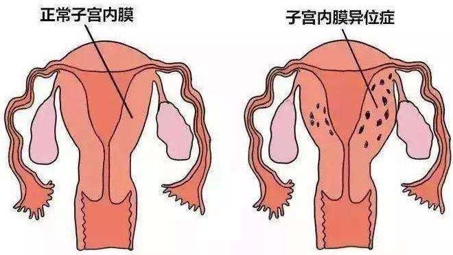 下面我们就来看看子宫内膜异位有什么影响? 什么是子宫内膜异位?