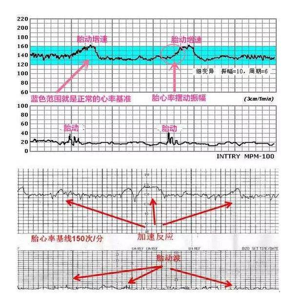 原创胎心监护为啥"上午不过下午过",是宝宝缺氧吗?小技巧孕妈收藏