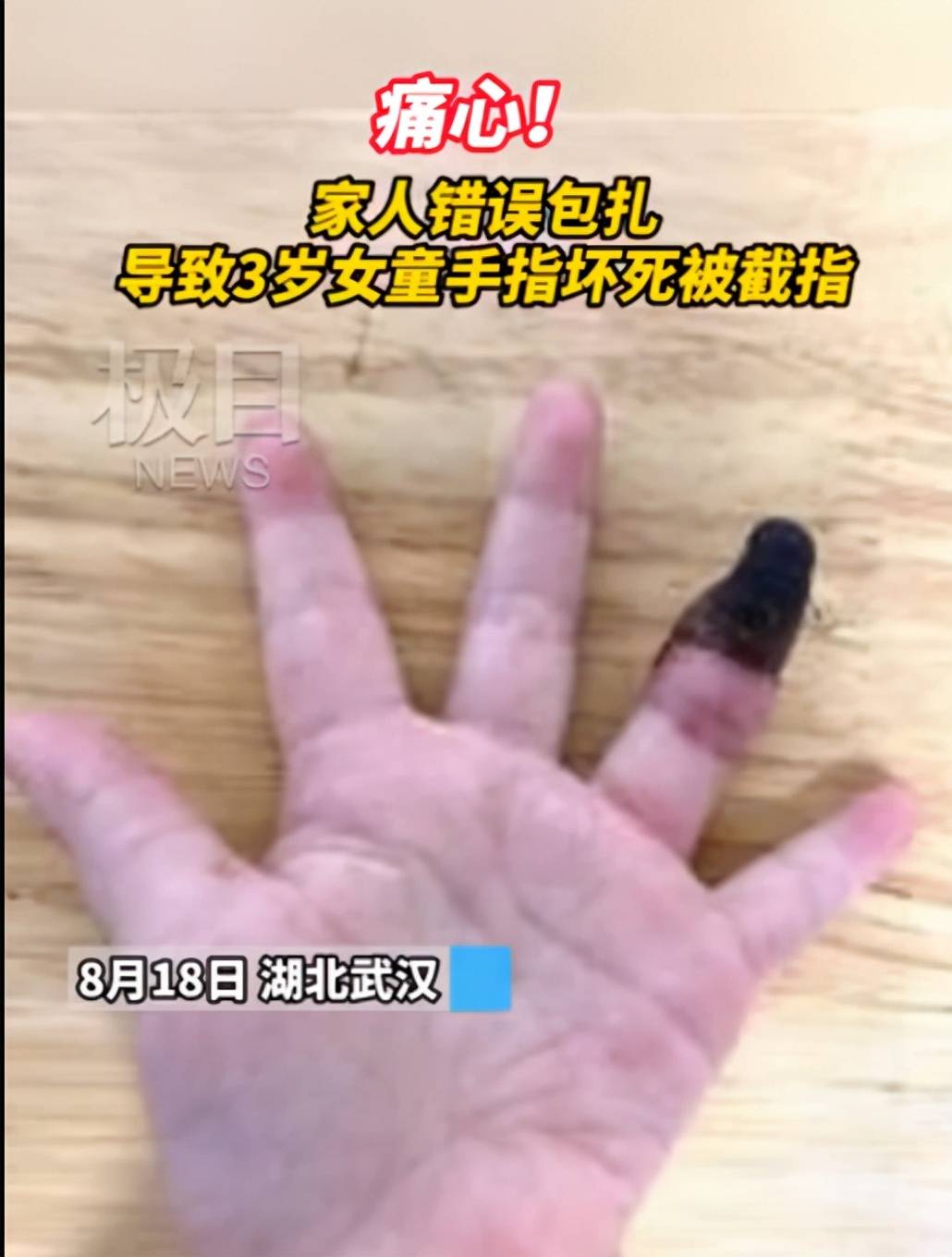 原创创可贴别乱用!奶奶错误包扎,致3岁女童手指坏死,医生:要截指