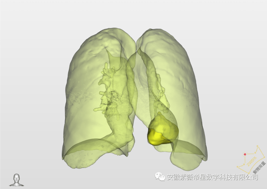 三维重建技术高效助力南京鼓楼医院肺隔离症手术