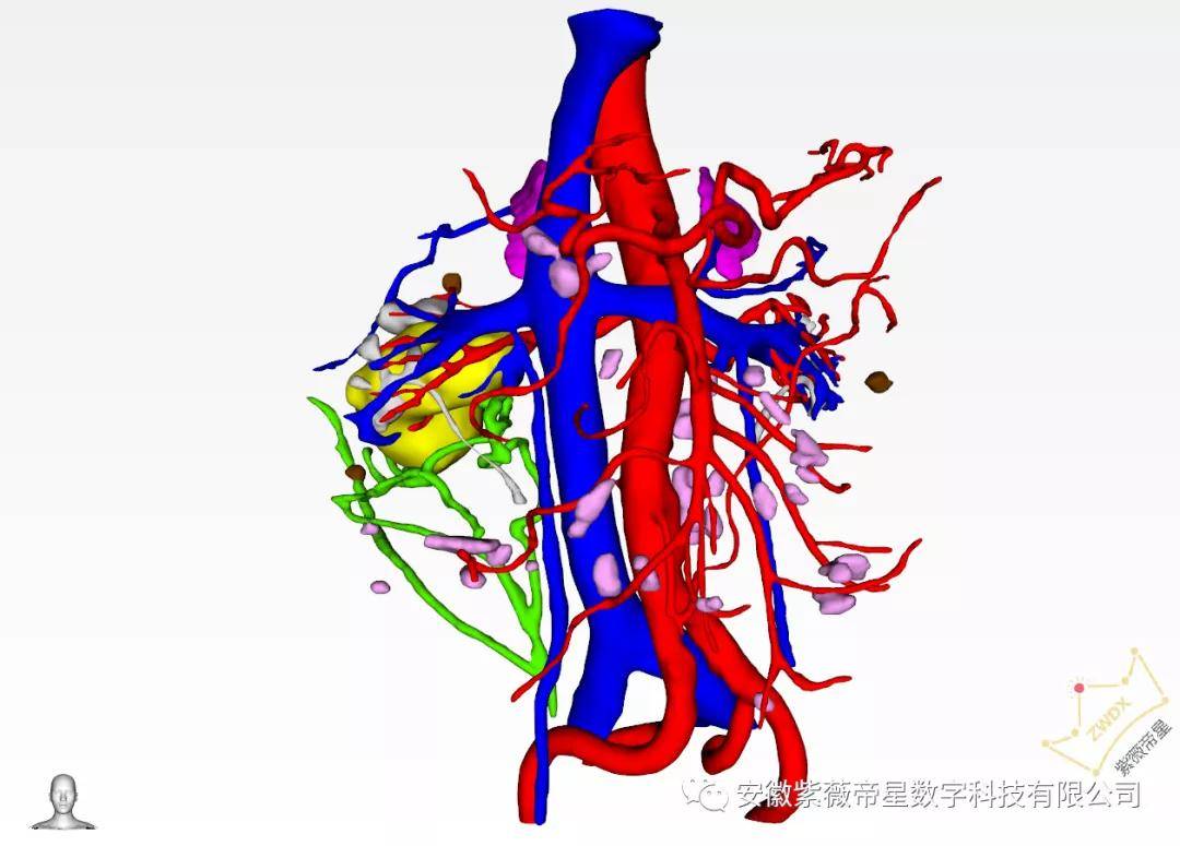 2 血管与占位,淋巴结关系