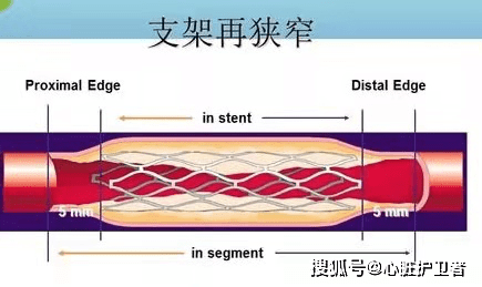 支架术后患者为什么仍感觉胸口不适