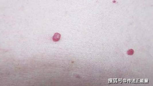 蜘蛛痣