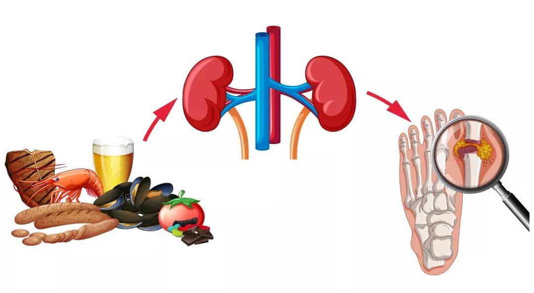 高尿酸可能不是嘌呤吃多了,而是出现了胰岛素抵抗
