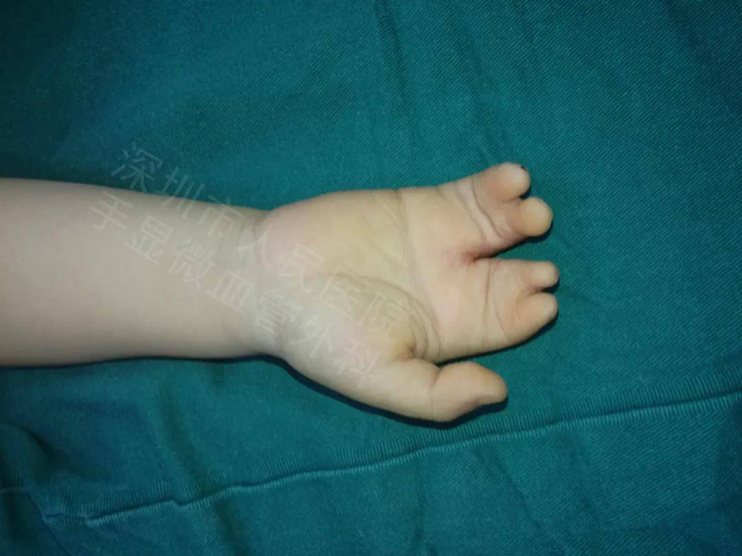狐大医|12岁男孩出生就得怪病,手指比香蕉还粗!7种常见手部畸形要注意