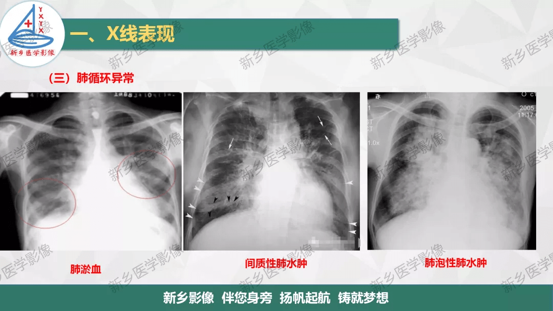 如何在胸片上观察心脏及血管的变化