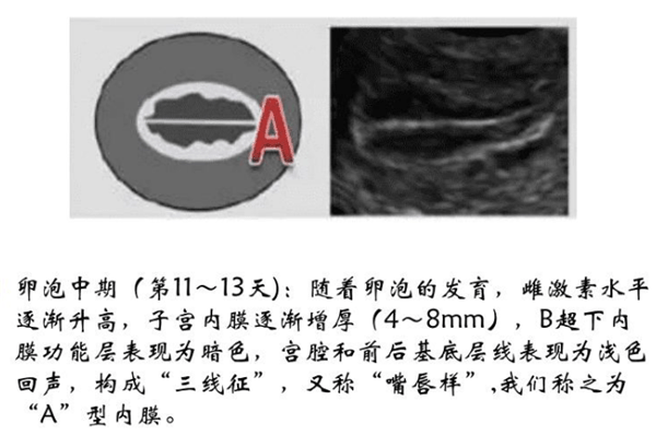 详解子宫内膜的厚度,类型及形态