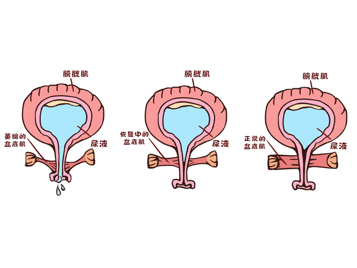 挤压着盆底肌肉,分娩后,产妇部分韧带会松裂,无法固定器官在正常位置