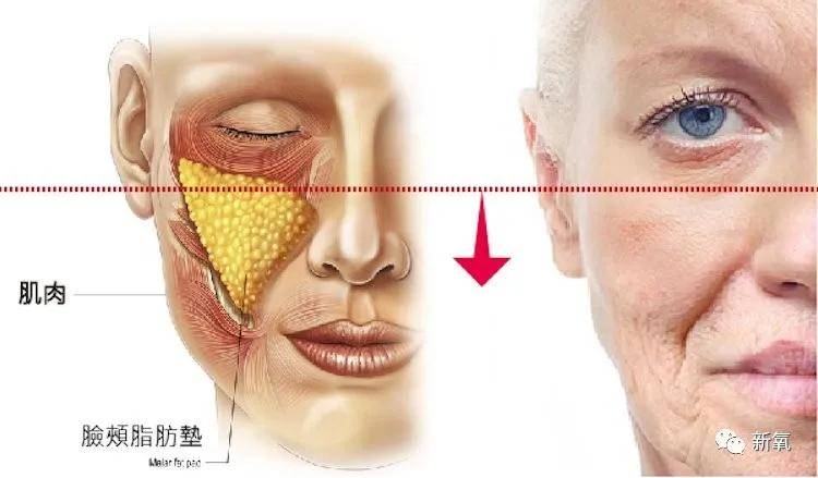 因为在婴儿吸奶时,发达的颊脂肪垫可以防止颊部塌陷.