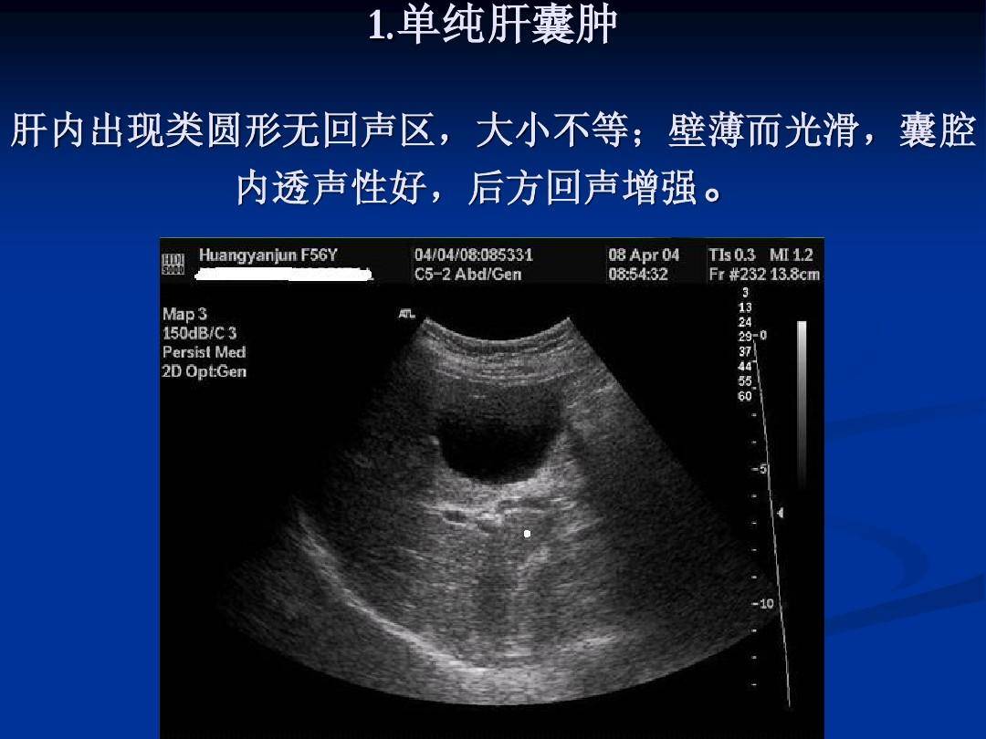 并且在超声波图像后端出现回音增强的情形,其实就是肝部的囊肿,或者称