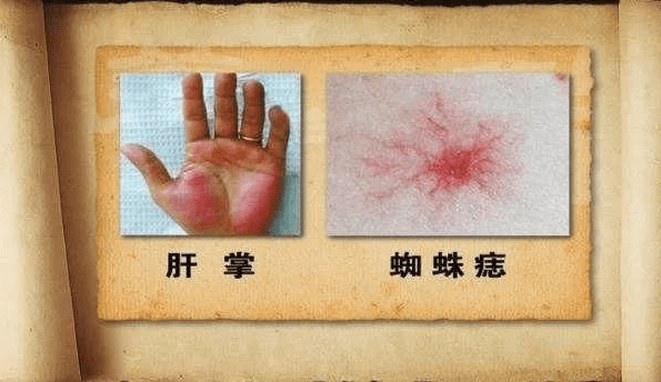 随着肝脏疾病的加重,雌激素慢慢沉积在皮肤上,导致蜘蛛痣的数量会增加