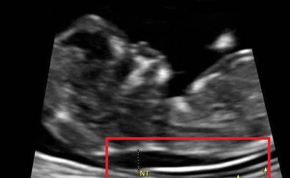 原创怀孕13周后一次重要产检,低于这个数值,基本不用担心胎儿畸形了