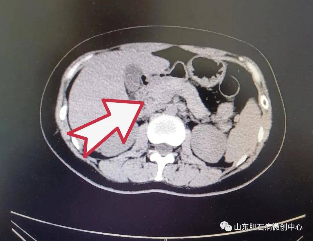 术前ct提示胆总管结石