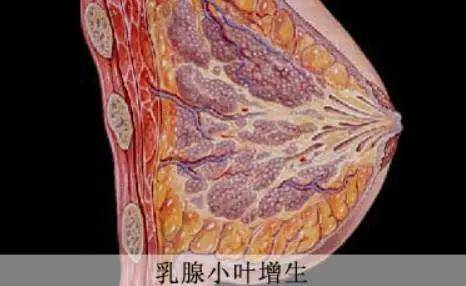 王劲主任分享:乳腺小叶增生要开刀吗?这几点千万别忽视!