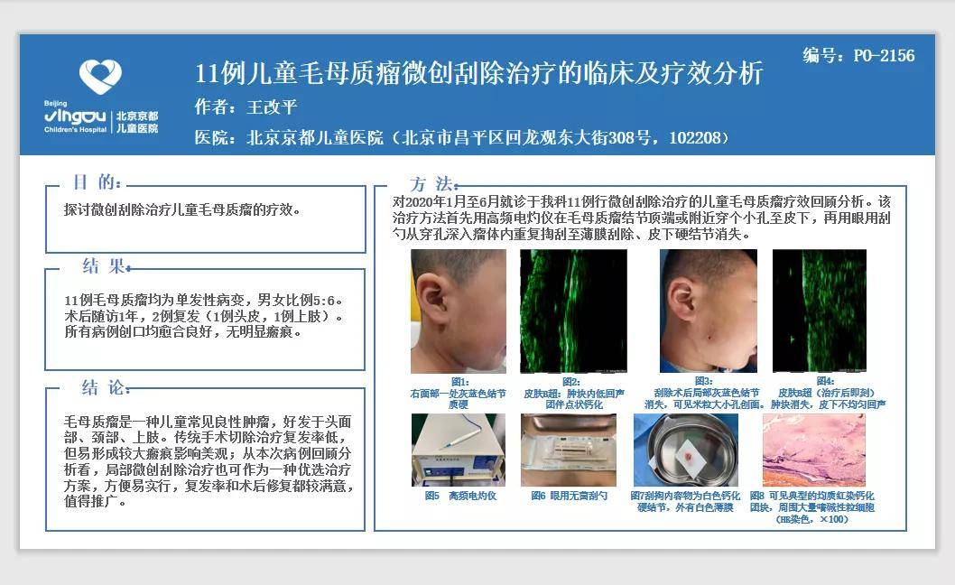 王改平医生壁报《11例儿童毛母质瘤微创刮除治疗的临床及疗效分析》郝