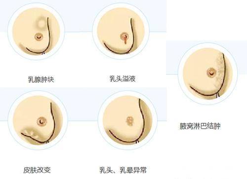 q2:早期乳腺癌的典型症状?