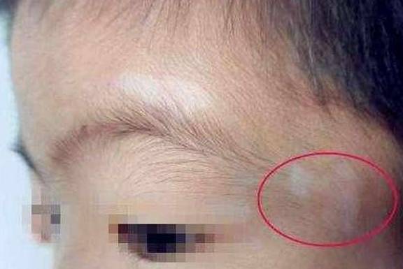 原创孩子有这些症状,可能是肚子里有蛔虫,宝妈们别大意