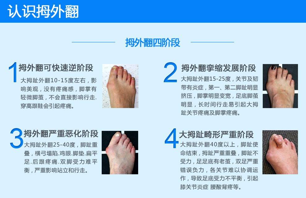 上海健桥医院拇外翻侯明主任:脚骨拐突出疼怎么治疗