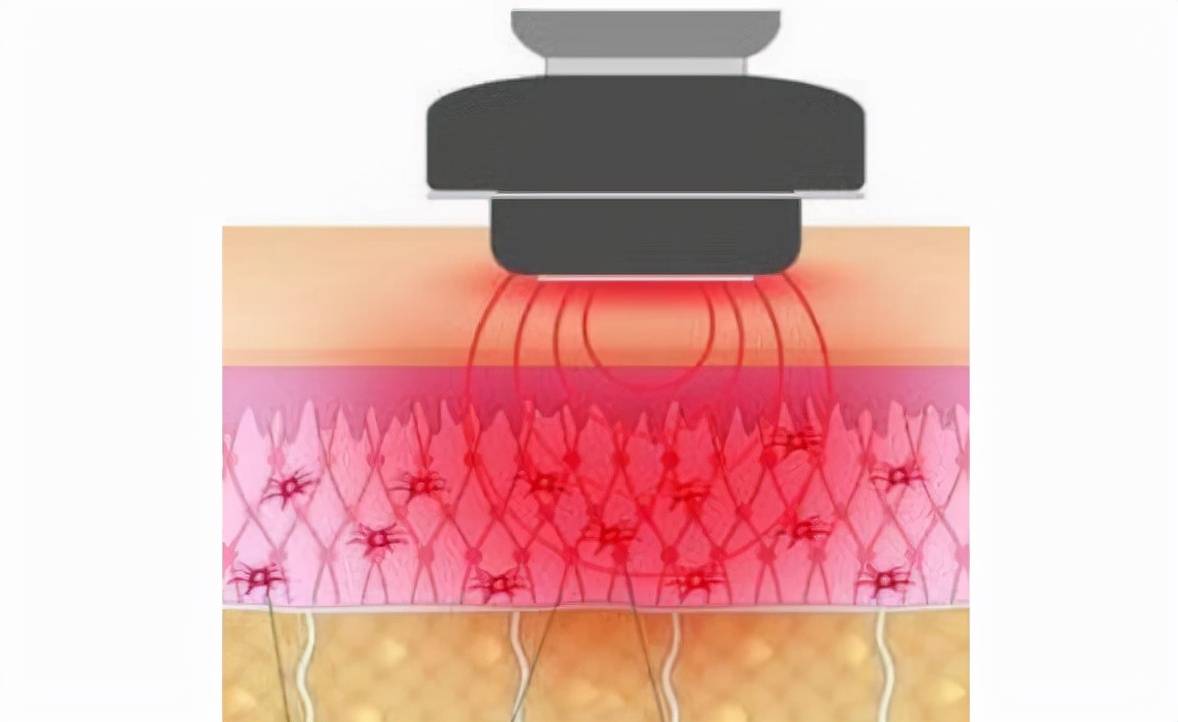 测评:射频紧肤和热玛吉的区别有哪些?资深讲述_皮肤_作用_组织