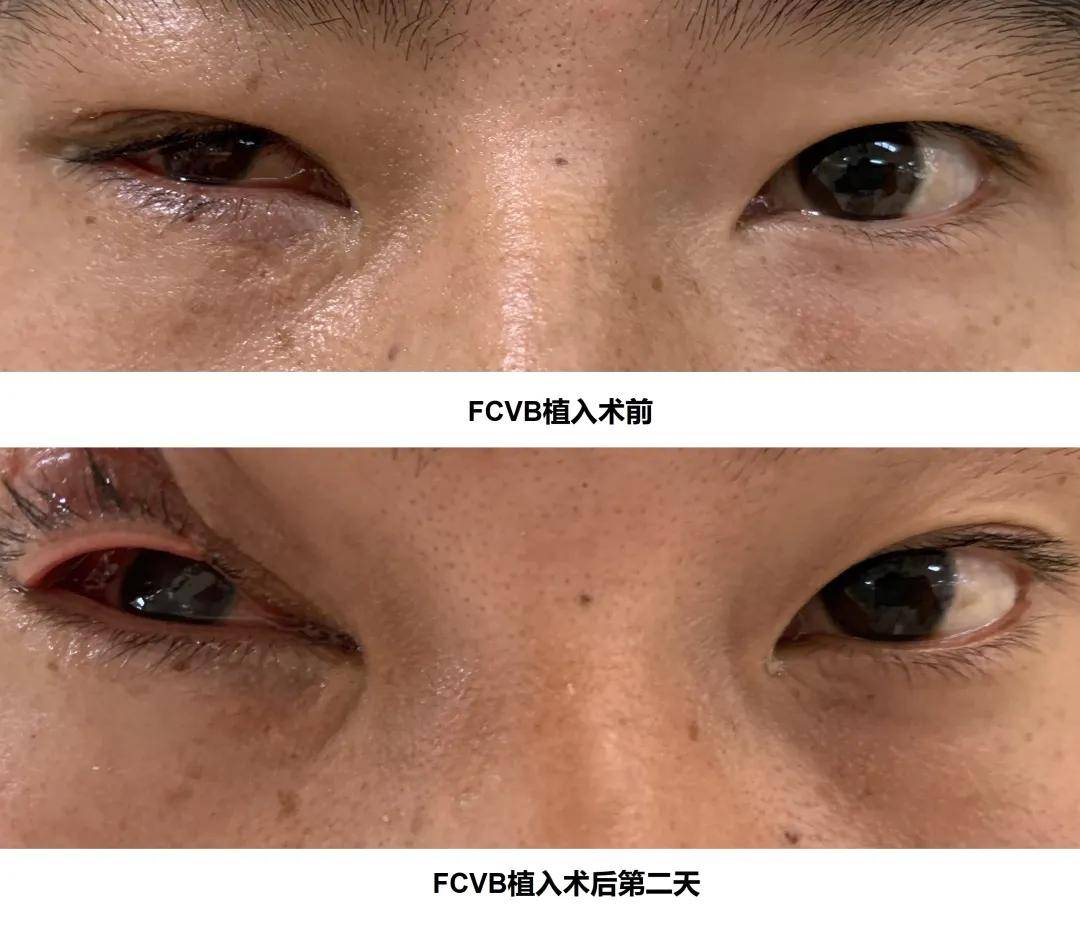 经历了右眼球i期修补术及ii期玻璃体切除 硅油注入术后,蒋炎云主任