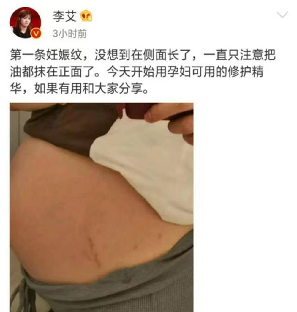 宝妈公敌＂妊娠纹＂,孕早期就要注意预防,晚了就没有后悔余地了