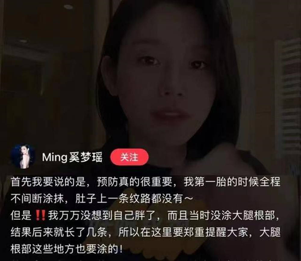 宝妈公敌＂妊娠纹＂,孕早期就要注意预防,晚了就没有后悔余地了