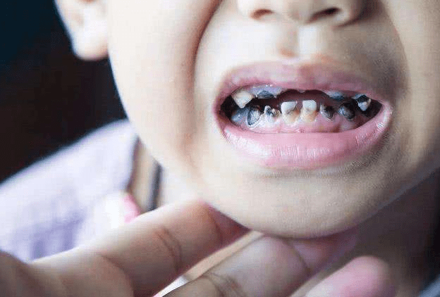 5岁孩子满口＂小黑牙＂,天天刷牙没效果？勿忽略＂1早3对＂