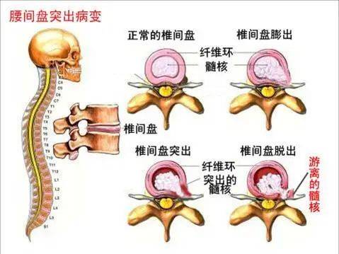 中医康复秋季来临腰椎间盘突出患者如何加强康复锻炼