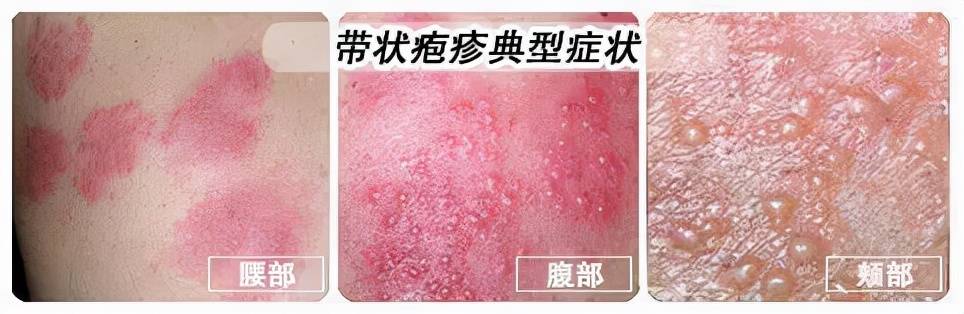 「蛇缠腰」找上门,妈妈痛得彻夜难眠!后悔没有早点儿打这个疫苗_患者_