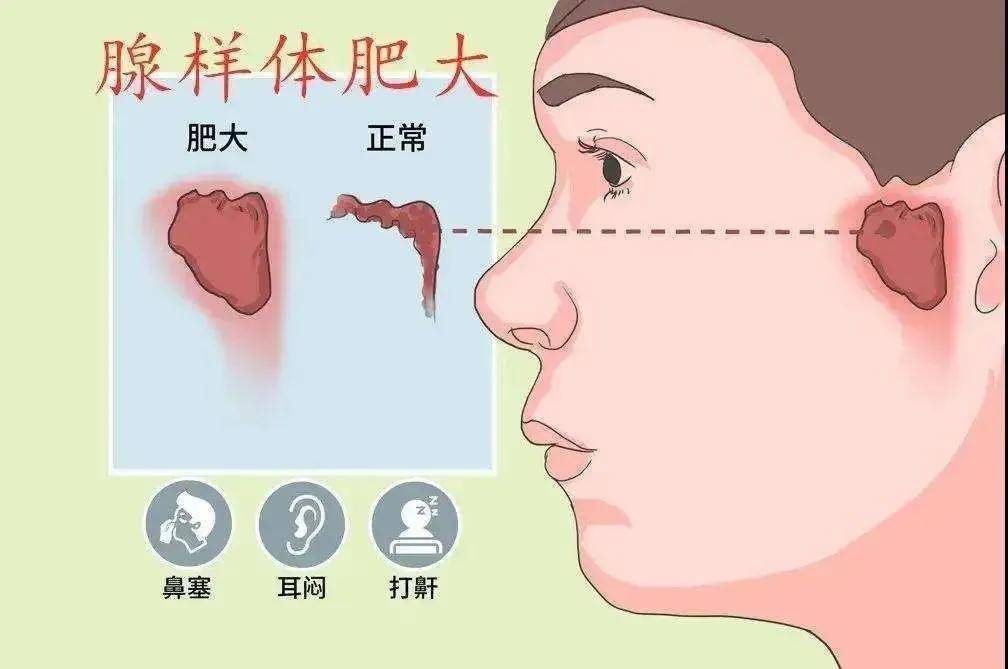 腺样体肥大会产生哪些并发症