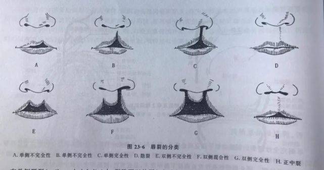 唇裂分度唇裂与腭裂的发生主要是由于妊娠前3个月发生胚胎口腔组织