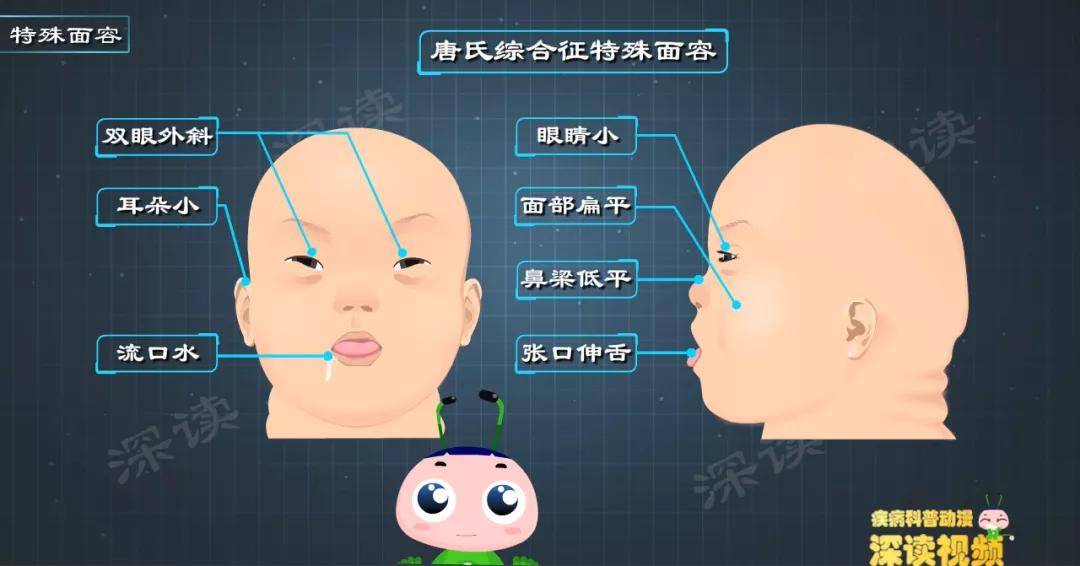 特殊面容是唐氏综合征的症状之一,具体表现为眼睛小,双眼外斜,面部