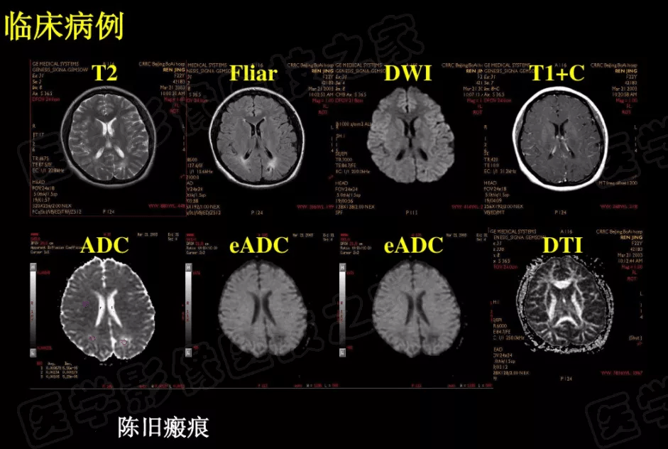 脑梗在磁共振弥散图像上信号的演变过程